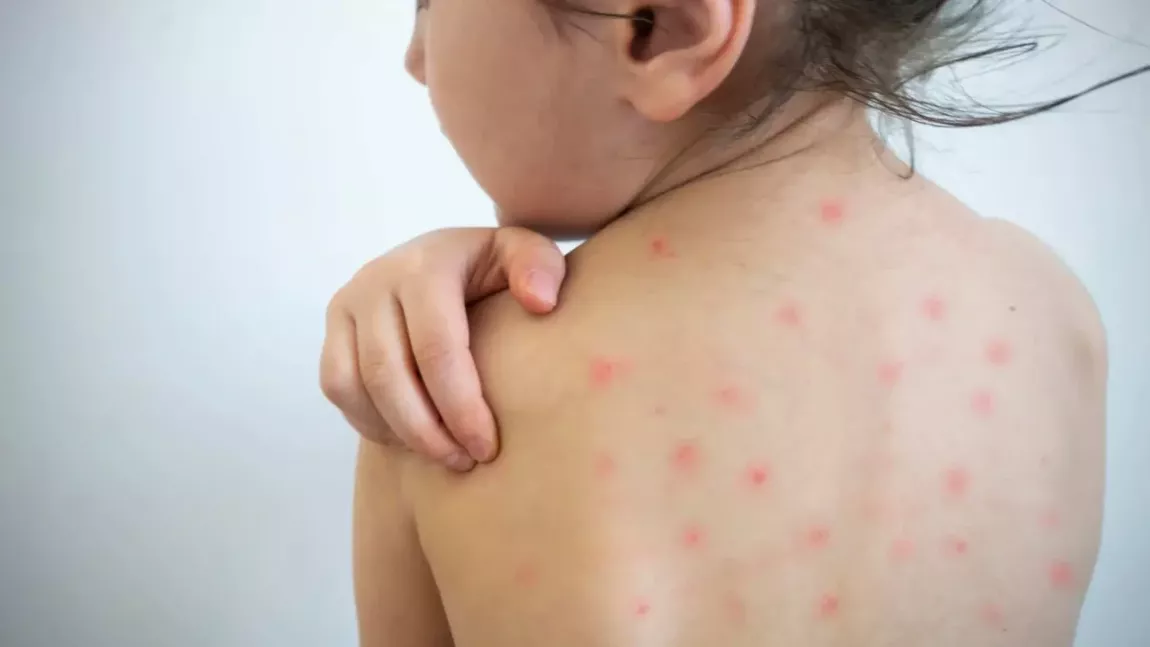 Cât durează varicela la adulți? Simptome și cum se transmite acest virus