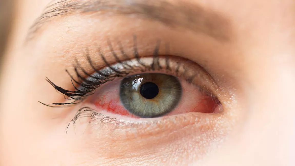 Ce sunt lacrimile artificiale și ce rol au acestea în protecția ochilor