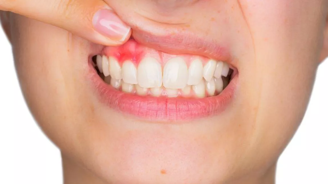 De ce apare infecția dentară? Bicarbonat de sodiu pentru ameliorarea durerii