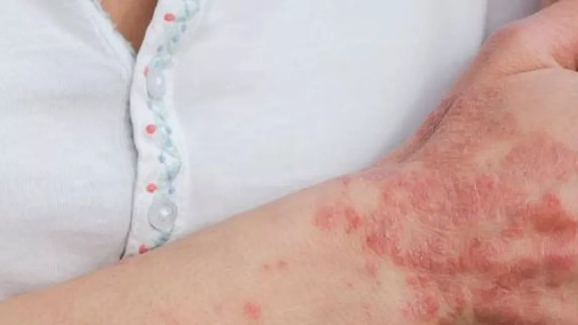 Psoriazis tratament. De ce apare această afecțiune a pielii?