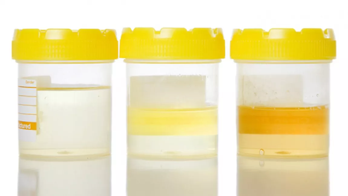Ce trebuie sa stii daca urina ta este albastruie, verde, galben stralucitor, portocalie, bruna sau roz