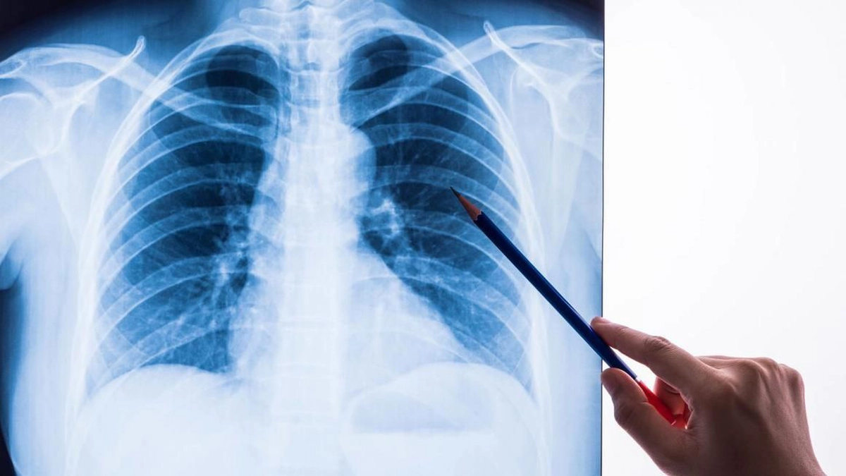 pneumonie