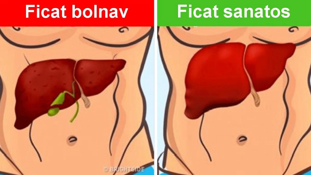 ficat sanatos