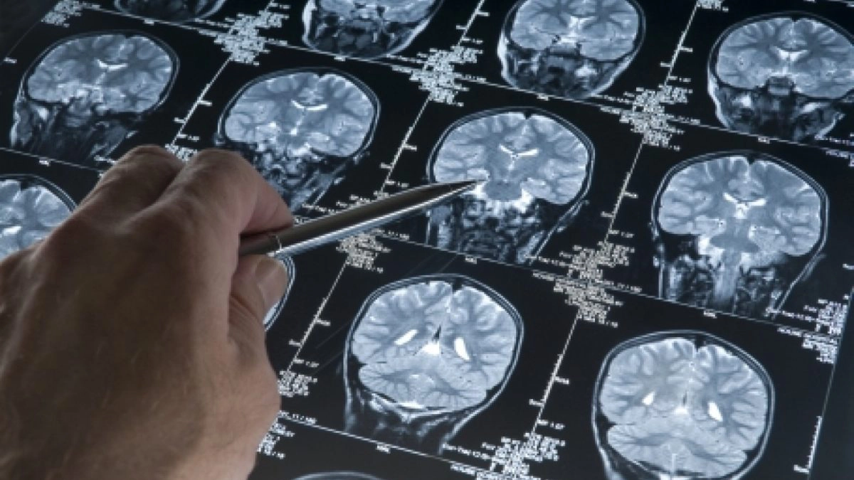 tomografii cerebrale