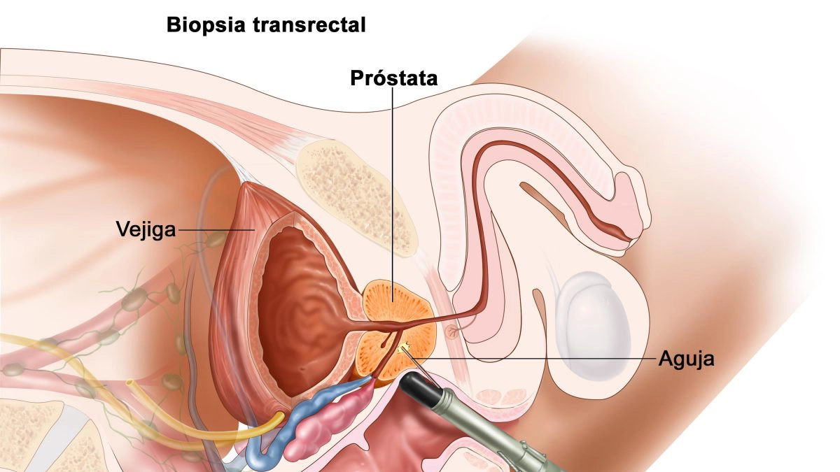 cancer-de-prostata
