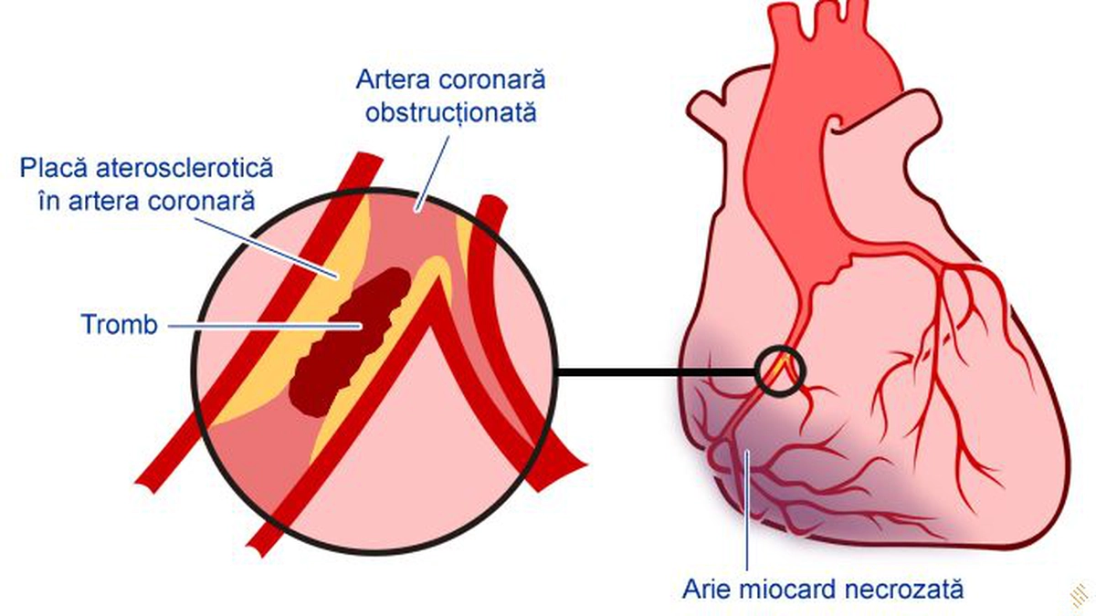 infarct miocardic
