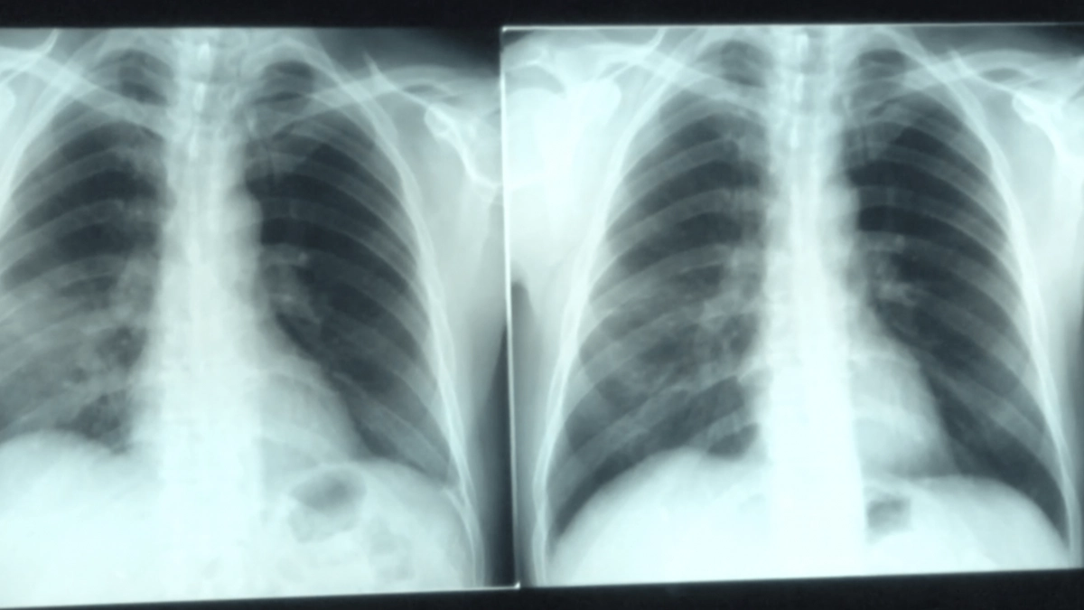 radiografie plamani