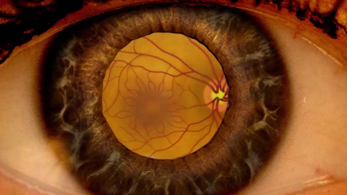 retinopatie diabetică
