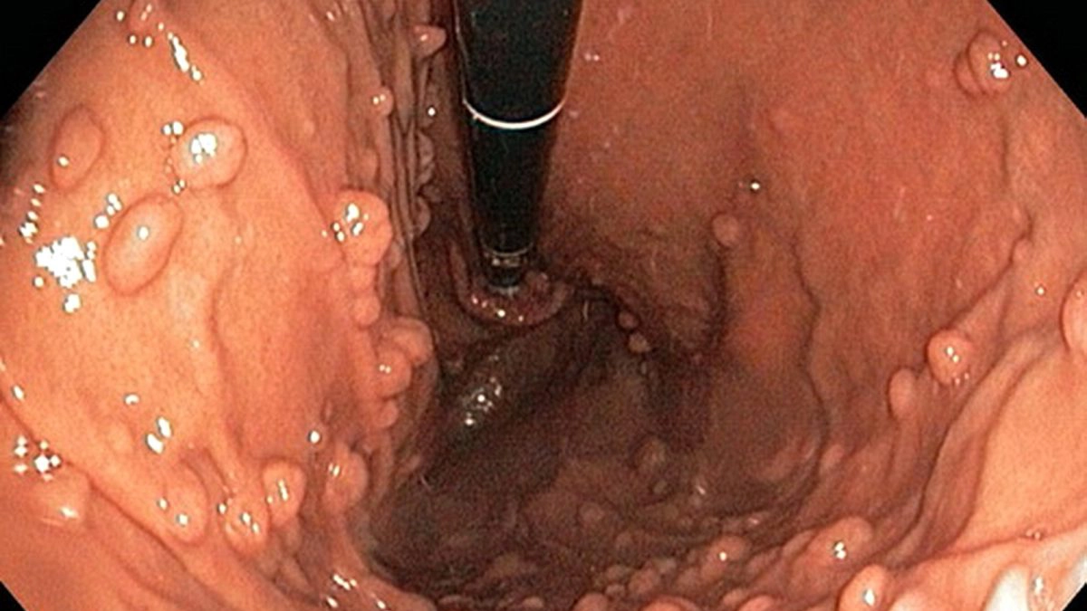Polipii intestinali