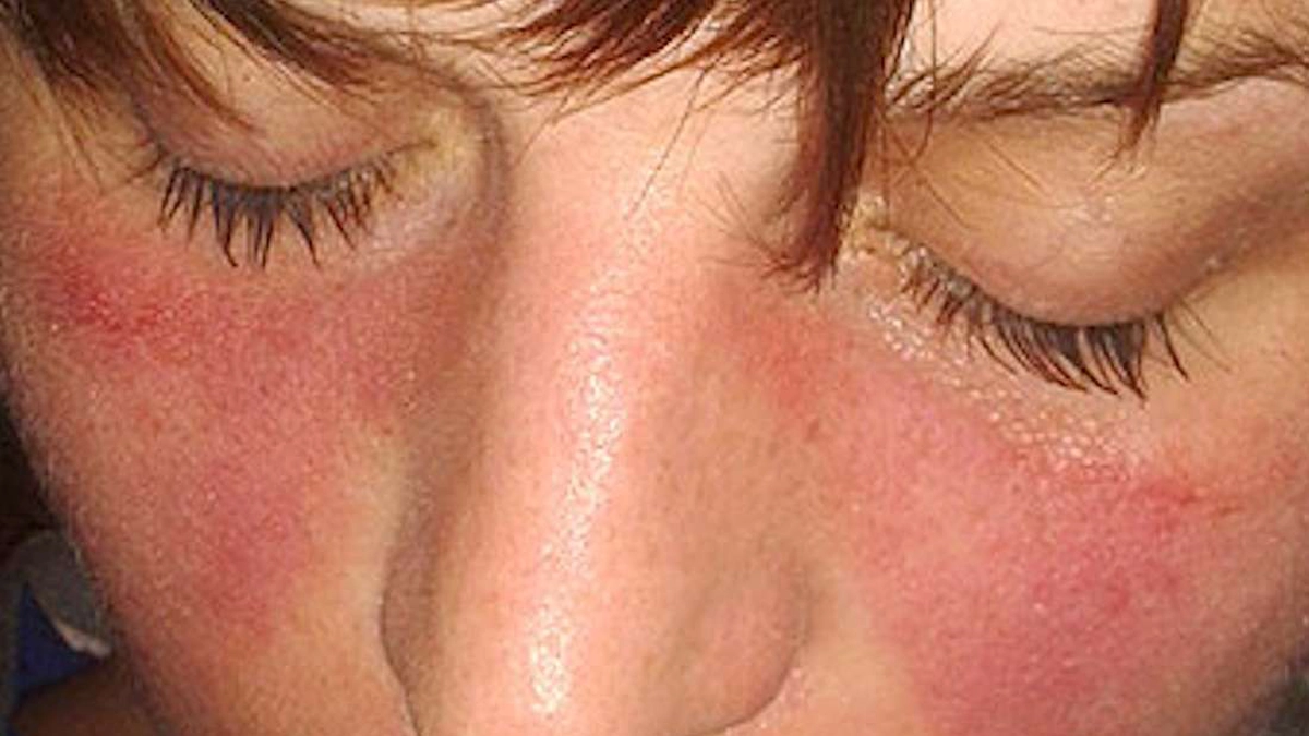 lupus