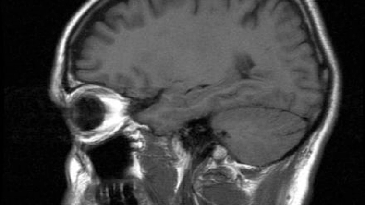 radiografie creier