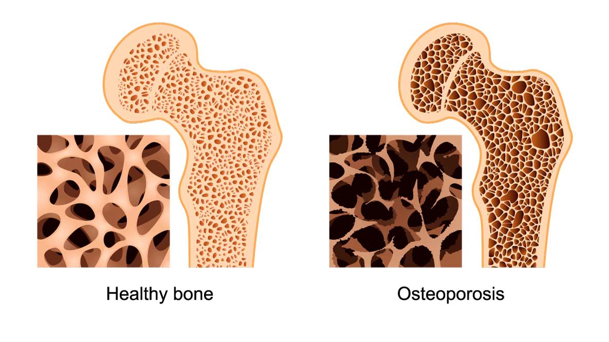 oase afectate de osteoporoza