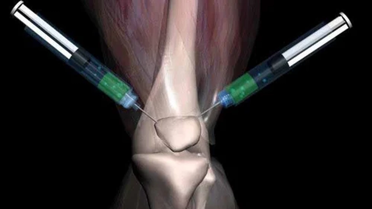Injectii-cu-colagen-in-genunchi-pret