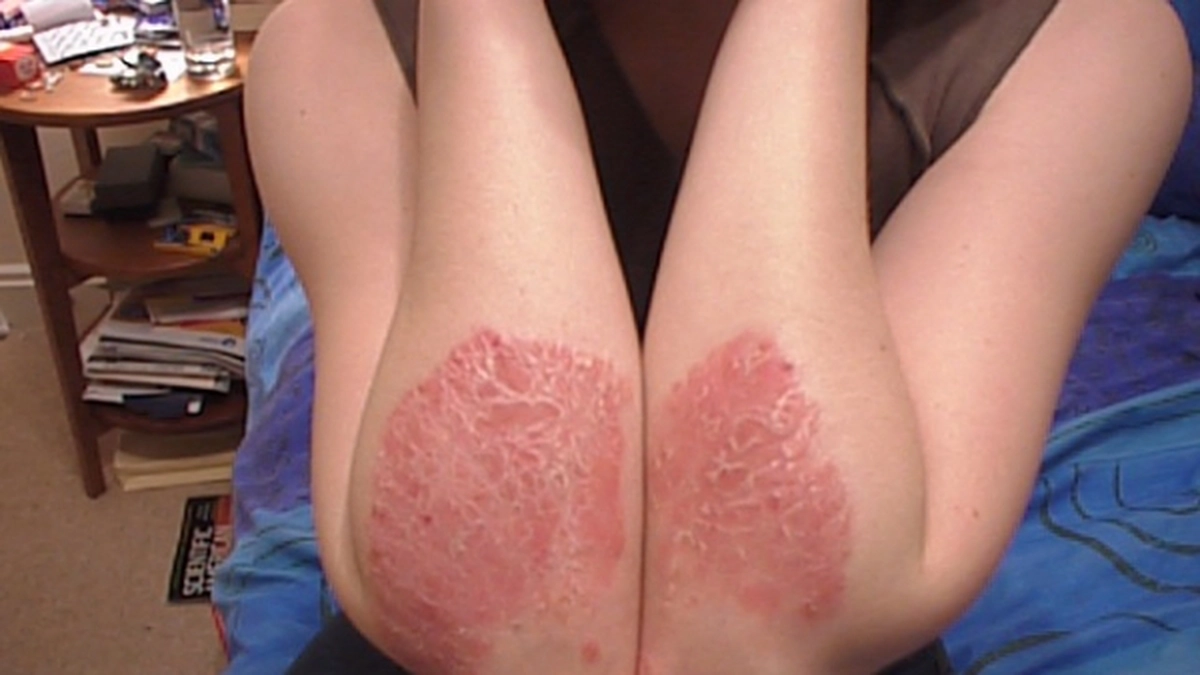 psoriazis_1.jpg