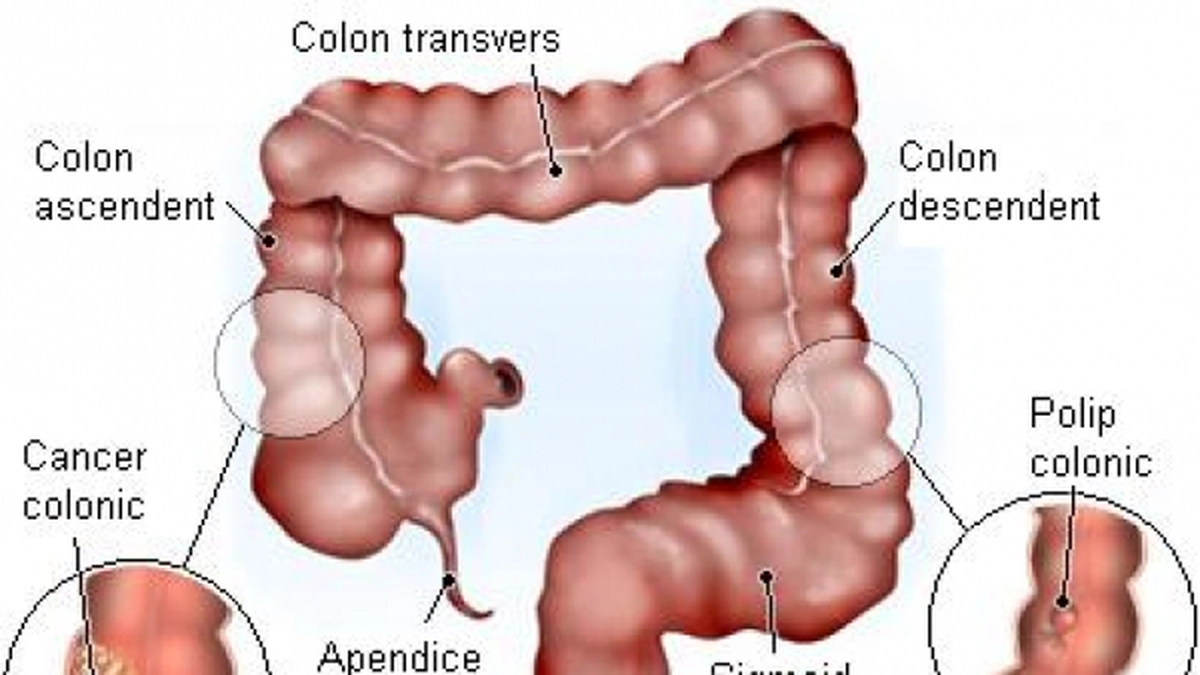 cancer_colon.jpg