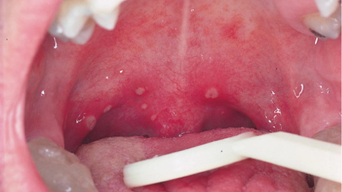 herpangina.jpg
