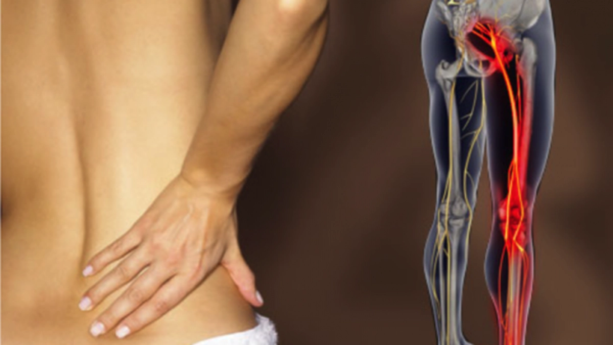 sciatica_1.png