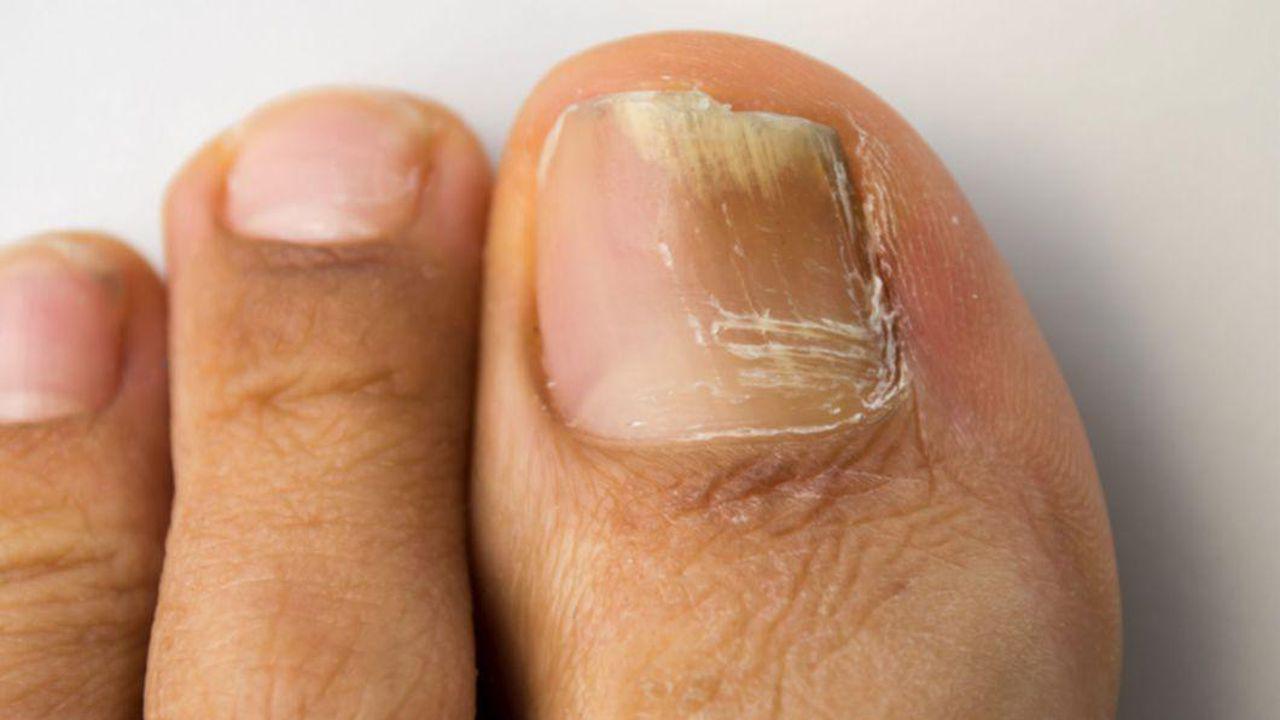 unghiile de la picioare afectate de o ciupercă ce să faci