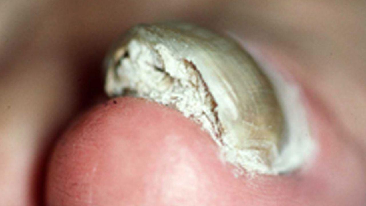 Metoda țărănească de a scăpa de ciuperca unghiilor: Cum să scapi de sâcâitoarea micoză a unghiilor