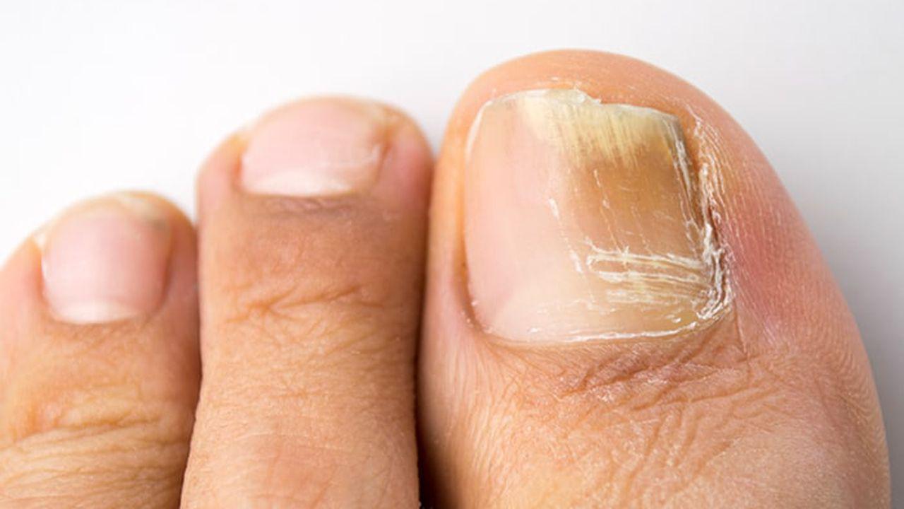tratamentul picioarelor și pantofilor pentru ciuperca unghiilor