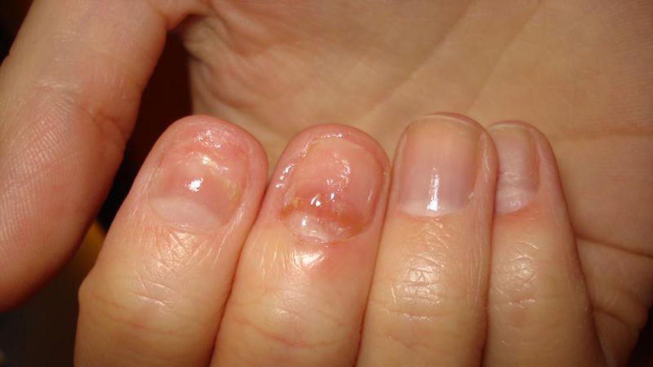 stadiu incipient al bolii ciupercii unghiilor