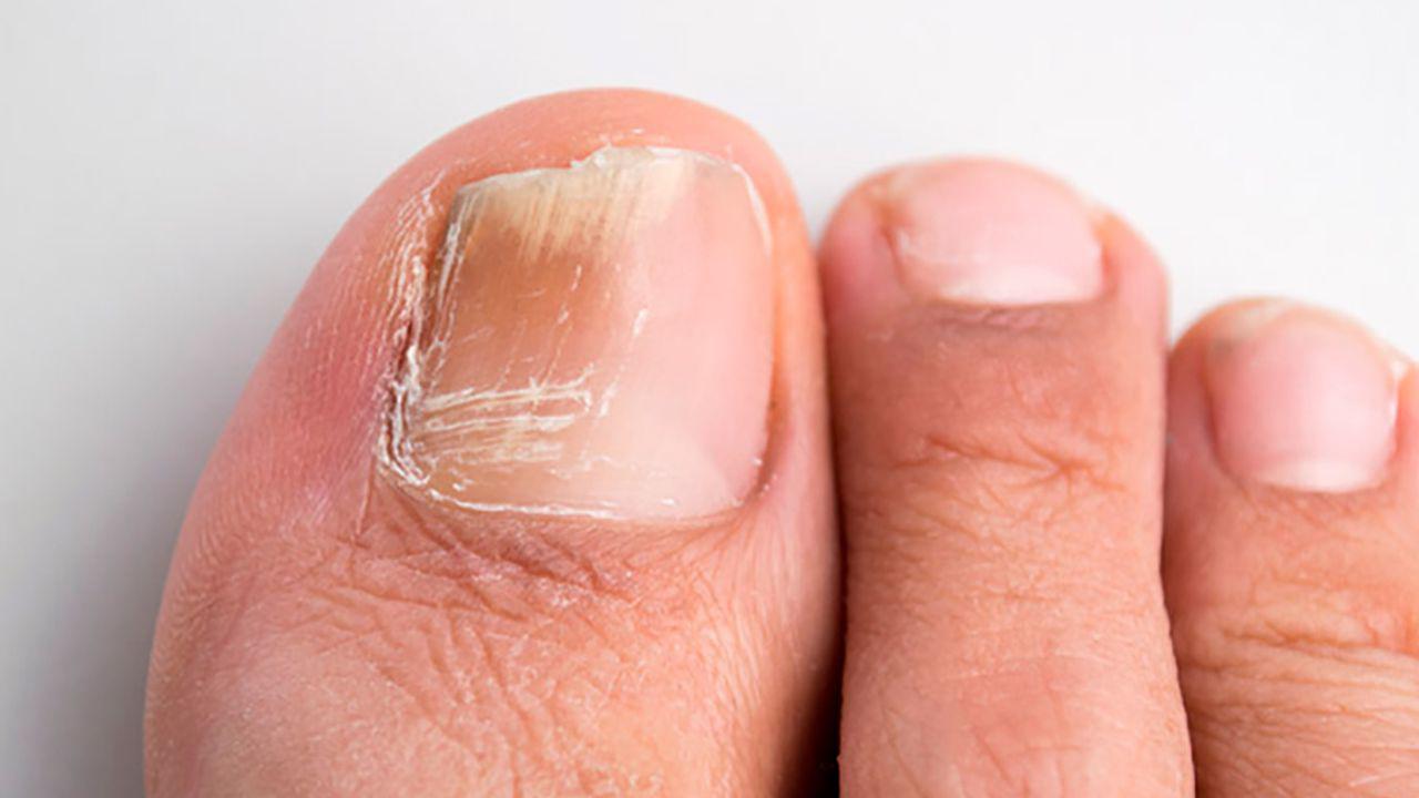 boli similare cu ciuperca unghiilor de la picioare