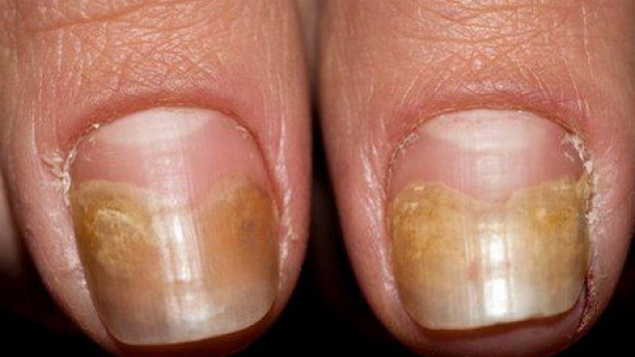 cum poți vindeca ciuperca unghiilor ce medicamente să luați pe cale orală pentru ciuperca unghiilor