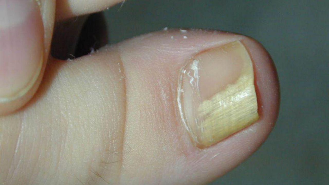 ciuperca marginii unghiilor
