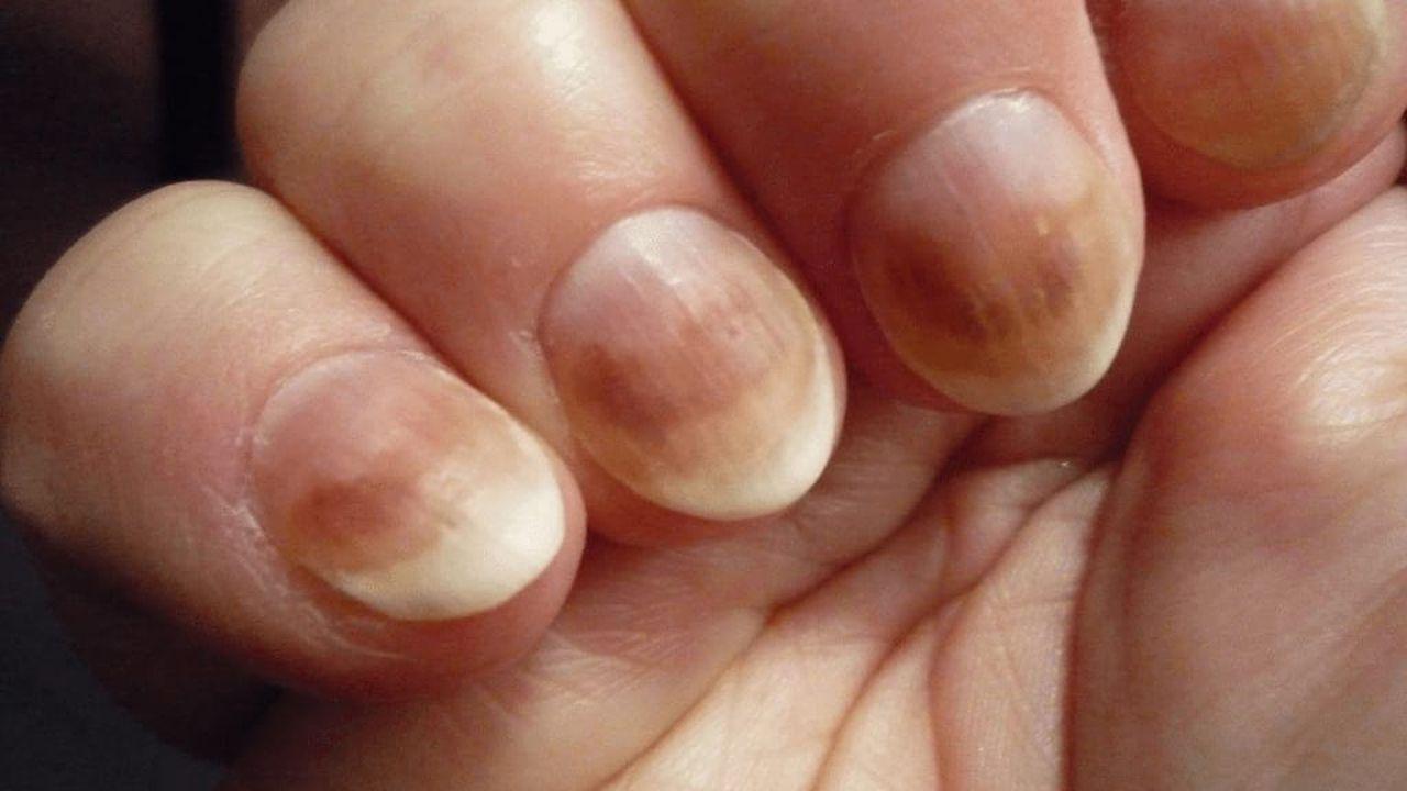efectul peroxidului asupra ciupercii unghiilor