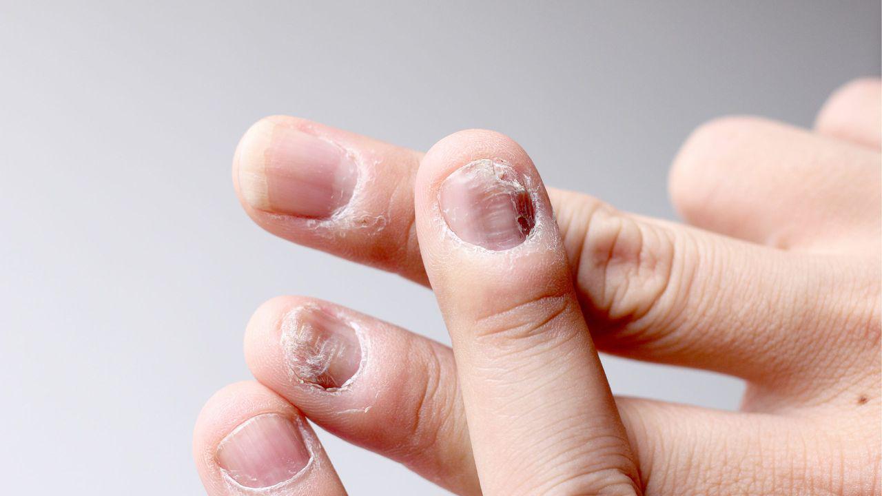 tratamentul ciupercii unghiilor formă avansată pe mâini