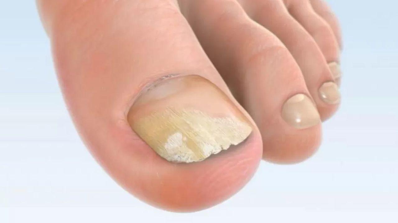Care este cel mai rapid mod de a vindeca ciuperca unghiilor de la picioare? uree pentru a trata ciuperca unghiilor