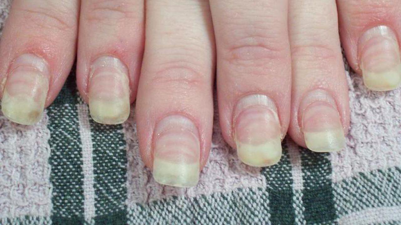 Mucegaiul pe unghii: cauze și tratament