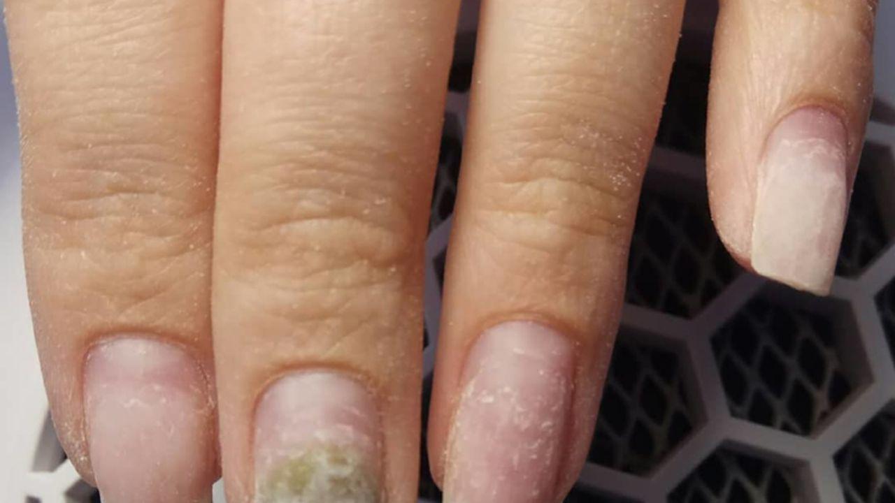 mucegaiul pe unghii este o ciupercă)