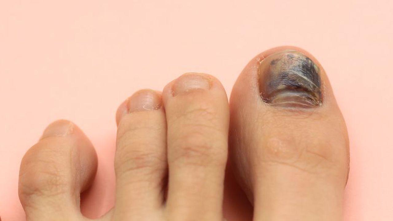 ce tip de ciupercă afectează unghiile de la picioare