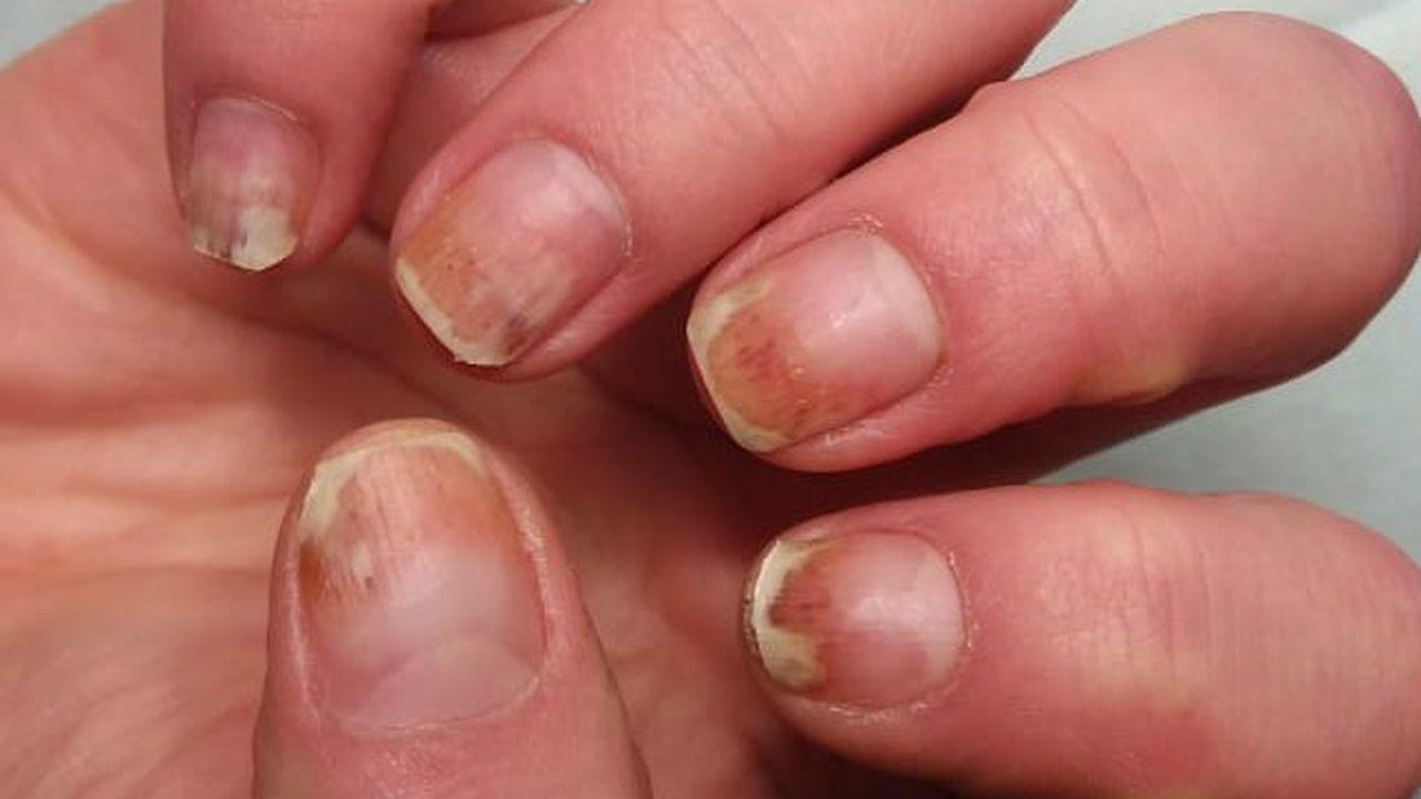 institut de tratare a ciupercilor unghiilor cum poți vindeca ciuperca unghiilor