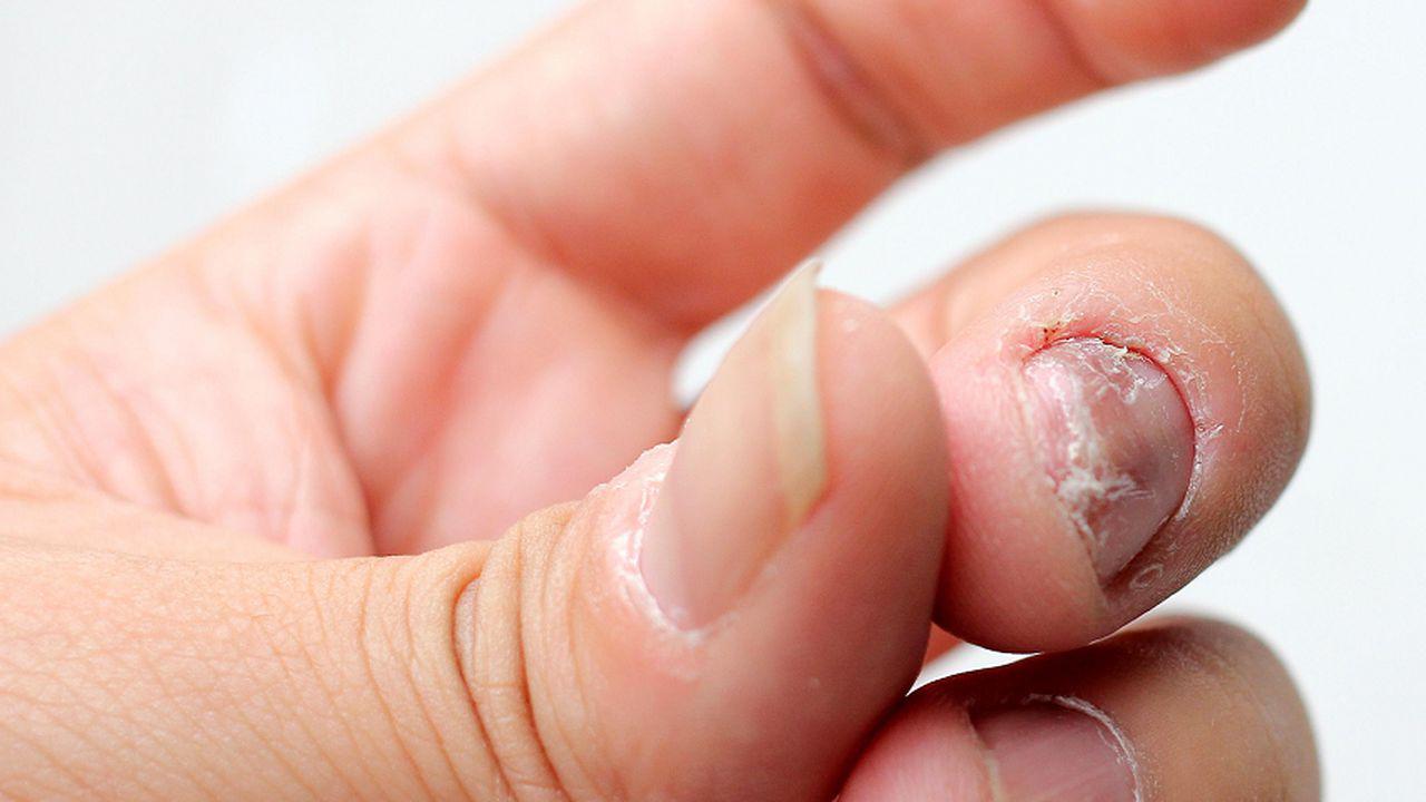 tratamentul ciupercii degetelor de la picioare ciuperca cade de pe unghie