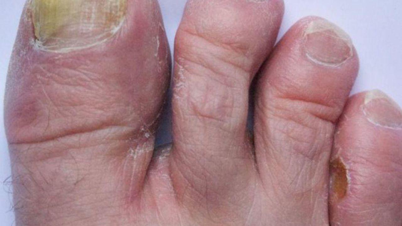 tratamentul ciupercii unghiilor cu săpun de rufe și iod dieta ciuperca unghiilor maini