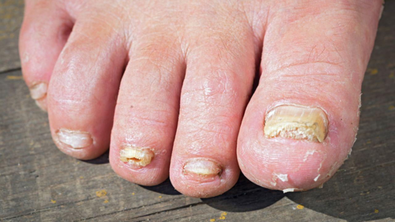 antibiotice pentru tratamentul ciupercii unghiilor de la picioare)