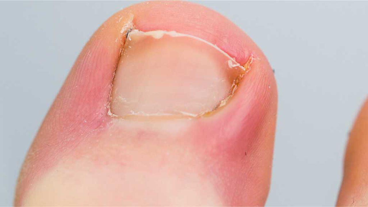 stadiu avansat al ciupercii de pe unghia de la picioare