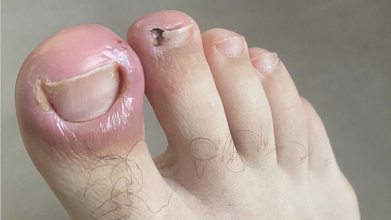 unghia incarnata de la picioare cu ciuperca unghiei