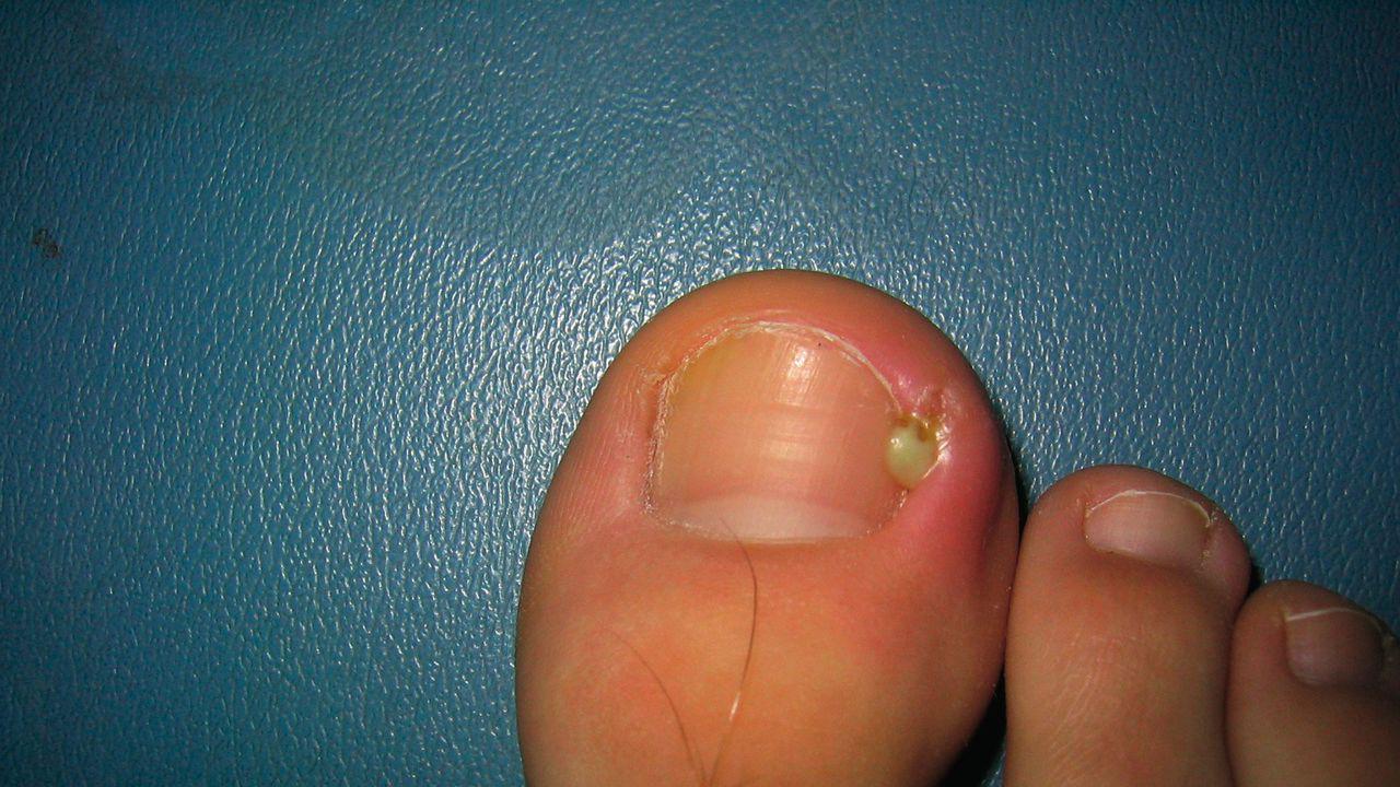 ciuperca pe unghiile de la picioare ca tratament pentru vânătăi