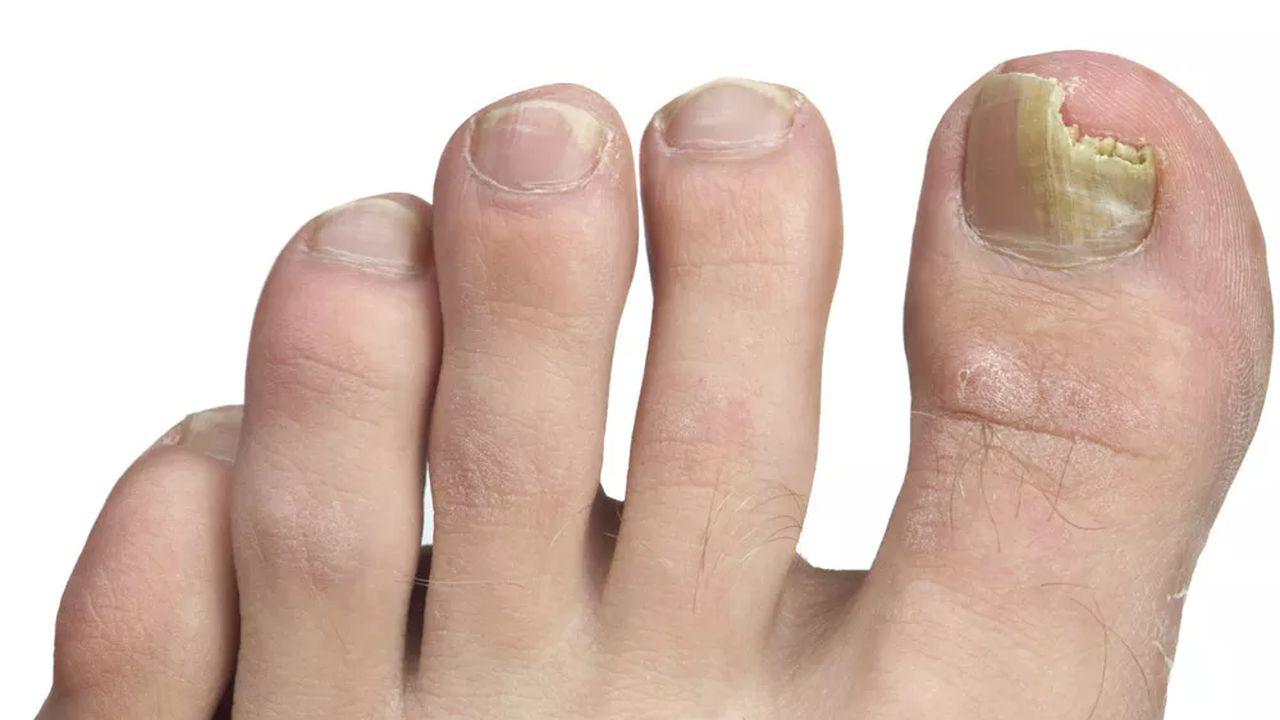 ciuperca pe unghiile de la picioare ca tratament pentru vânătăi