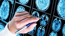Studiu tulburător: pandemia a accelerat îmbătrânirea creierului! Cine e cel mai afectat