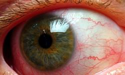 tratament tras curent ochi verificarea ochilor pentru miopie