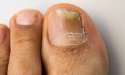 Ce remediu popular poate scăpa de ciuperca unghiilor de la picioare?
