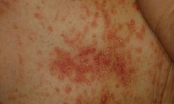 Foto Cum Recunoastem Psoriazisul Buna Ziua Iasi Bzi Ro