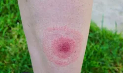 Poze boala Lyme  tot ce trebuie să știi despre această infecție