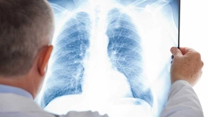 Toate persoanele de peste 18 ani pot beneficia, de la 1 iulie, de radiografii pulmonare gratuite! Trebuie doar să se prezinte la medic cu o copie a cărții de identitate