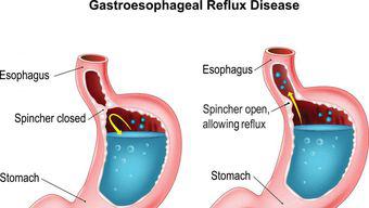 Trucuri simple care combat greața cauzată de refluxul gastroesofagian