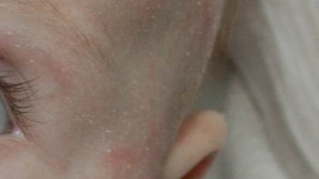 Afectiuni curente ale pielii copiilor